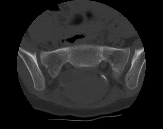 Aneurysmal bone cyst - sacrum (Radiopaedia 65190-74195 Axial bone window 20).jpg