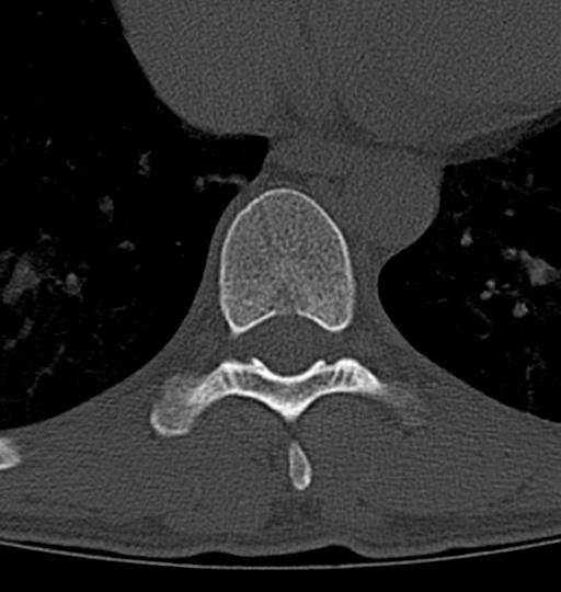Aneurysmal bone cyst T11 (Radiopaedia 29294-29721 Axial bone window 24).jpg