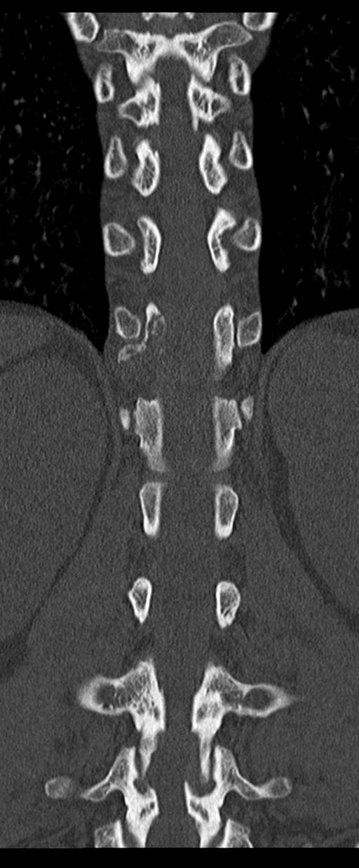 Aneurysmal bone cyst T11 (Radiopaedia 29294-29721 Coronal bone window 39).jpg