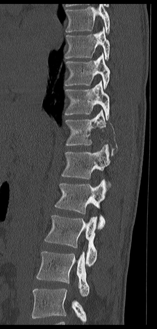 Aneurysmal bone cyst T11 (Radiopaedia 29294-29721 Sagittal bone window 48).jpg