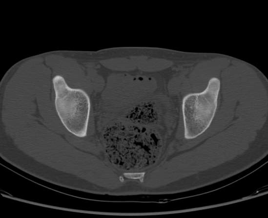 File:Aneurysmal bone cyst of ischium (Radiopaedia 25957-26094 Axial bone window 48).png