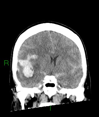 Aneurysmal subarachnoid hemorrhage with intra-axial extension (Radiopaedia 84371-99699 Coronal non-contrast 40).jpg