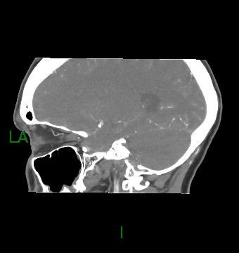 Aneurysmal subarachnoid hemorrhage with intra-axial extension (Radiopaedia 84371-99732 B 24).jpg