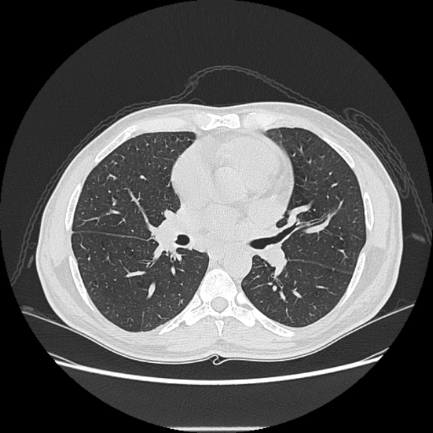 Angioinvasive aspergellosis (Radiopaedia 66995-76315 Axial lung window 25).jpg