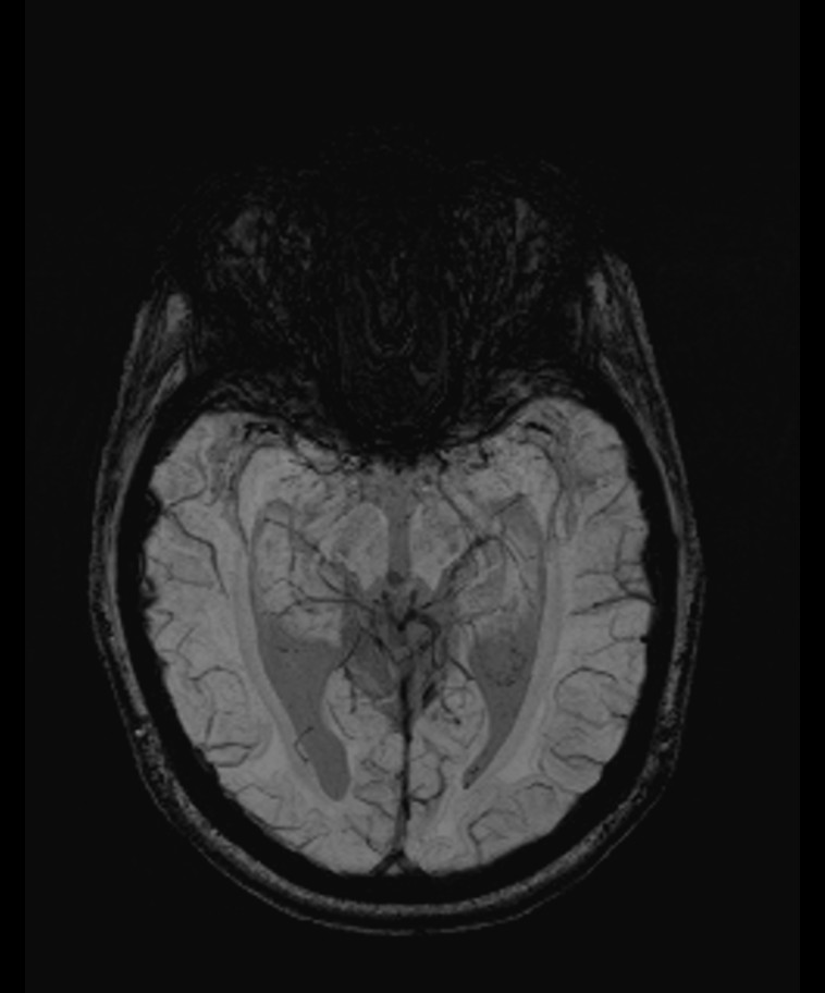 Angiomatous meningioma (Radiopaedia 79459-92579 E 27).jpg