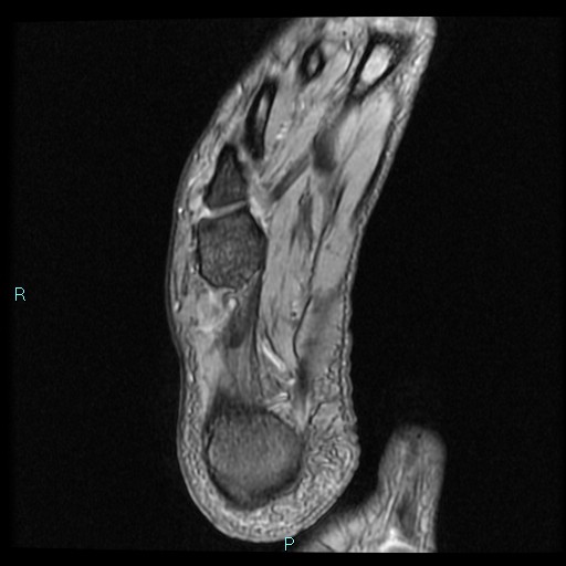 Ankle ganglion cyst (Radiopaedia 62809-71162 Axial Gradient Echo 9).jpg