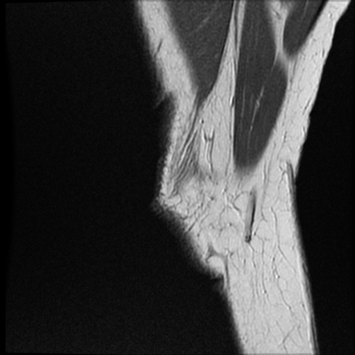 Anomalous insertion of the medial meniscus (Radiopaedia 77559-89721 Sagittal PD 50).jpg
