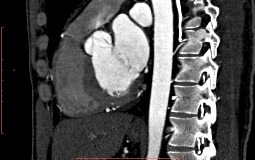 Anomalous left coronary artery from the pulmonary artery (ALCAPA) (Radiopaedia 70148-80181 C 134).jpg