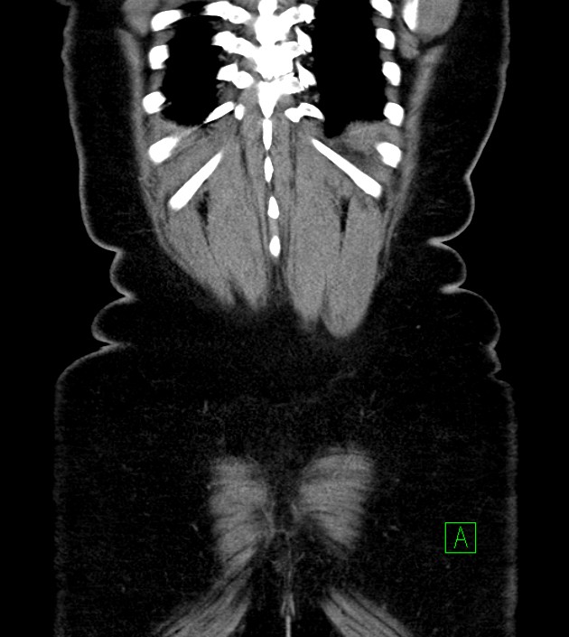 Anterior abdominal wall CSF pseudocyst (CSFoma) (Radiopaedia 79453-92571 B 50).jpg