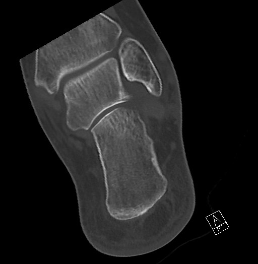 File:Anterior calcaneal process fracture (Radiopaedia 63353-71943 Axial bone window 110).jpg
