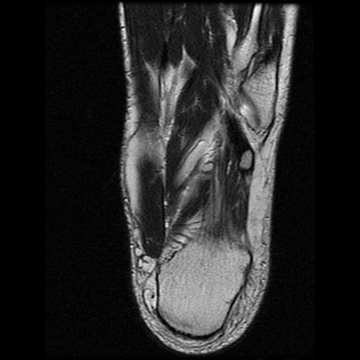 File:Anterior calcaneal process fracture (Radiopaedia 74654-85611 Axial T2 26).jpg