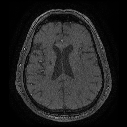 Anterior cerebral artery infarction (Radiopaedia 46794-51323 Axial MRA 140).jpg