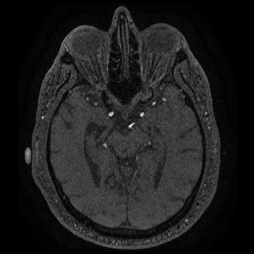 Anterior cerebral artery infarction (Radiopaedia 46794-51323 Axial MRA 82).jpg
