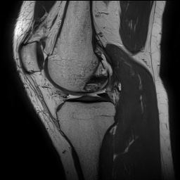 Anterior cruciate ligament rupture and posteromedial corner injury (Radiopaedia 67338-76723 Sagittal PD 69).jpg