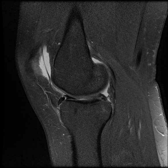 File:Anterior cruciate ligament tear, Wrisberg rip and bucket-handle tear of medial meniscus (Radiopaedia 75872-87266 Sagittal PD fat sat 17).jpg