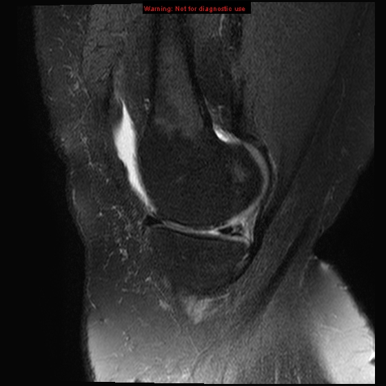 File:Anterior cruciate ligament tear - complete (Radiopaedia 12175-12514 Sagittal T2 fat sat 16).jpg