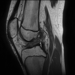 File:Anterior cruciate ligament tear - pediatric (Radiopaedia 62152-70260 Sagittal PD 91).jpg