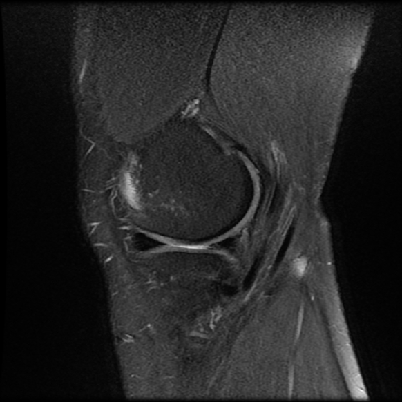 File:Anterior cruciate ligament tear with posteromedial corner injury, bucket-handle meniscal tear and chondral delamination (Radiopaedia 75501-86744 Sagittal PD fat sat 5).jpg