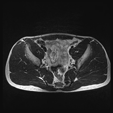 File:Anterior inferior iliac spine avulsion fracture (Radiopaedia 81312-95000 Axial T2 28).jpg