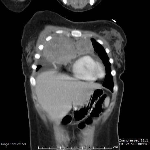 File:Anterior mediastinal B cell Lymphoma (Radiopaedia 50677-56114 B 6).jpg