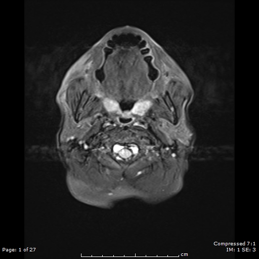 File:Anterior temporal lobe perivascular space (Radiopaedia 88283-104914 Axial FLAIR 1).jpg