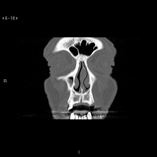 File:Antrochoanal Polyp (Radiopaedia 70510-80631 Coronal bone window 7).jpg