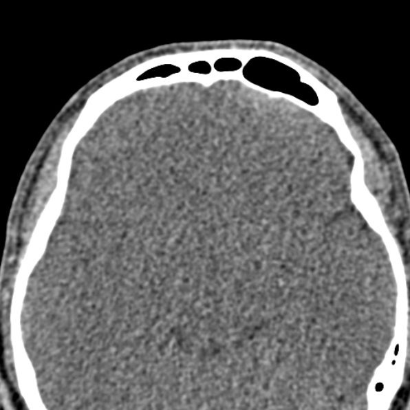 Antrochoanal polyp (Radiopaedia 30002-30554 Axial non-contrast 48).jpg
