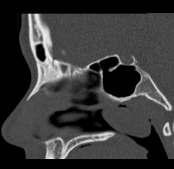 Antrochoanal polyp (Radiopaedia 33984-35202 Sagittal bone window 40).jpg