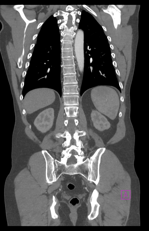 Aortectomy and axillary-bifemoral bypass (Radiopaedia 28303-28545 C 67).jpg