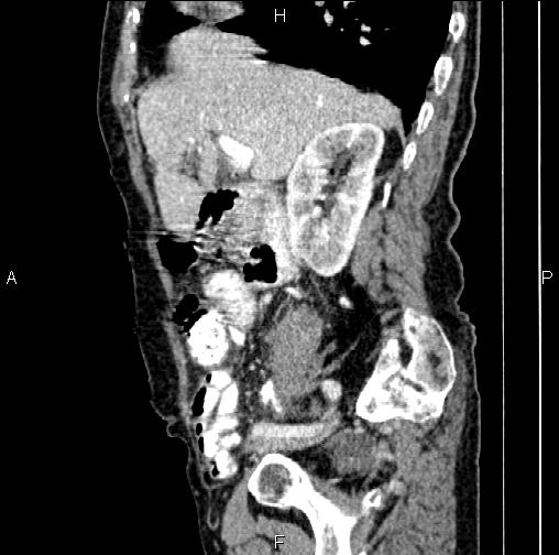 File:Aortic aneurysm and Lemmel syndrome (Radiopaedia 86499-102554 D 28).jpg