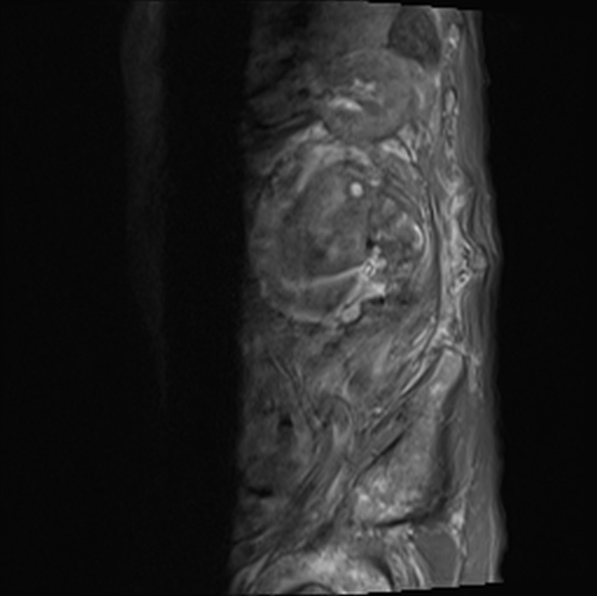 File:Aortic aneurysm with spinal destruction (Radiopaedia 42301-45409 Sagittal T1 fat sat 38).jpg