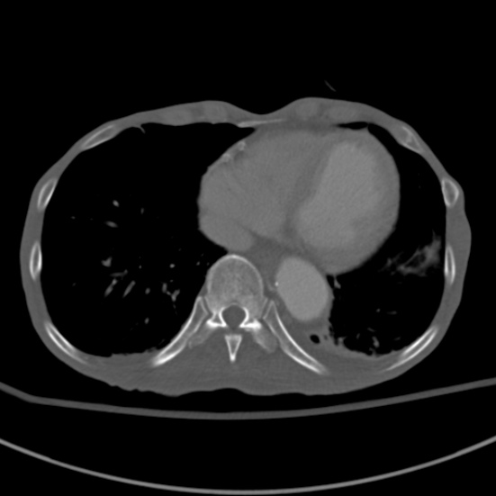 Aortic aneurysm with spinal destruction (Radiopaedia 42301-45410 Axial bone window 1).jpg