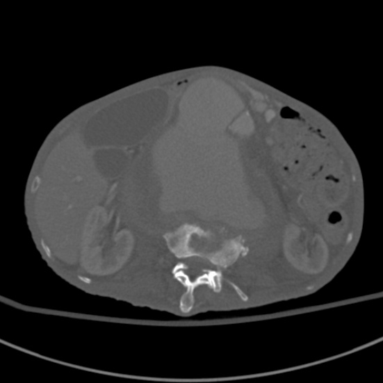 Aortic aneurysm with spinal destruction (Radiopaedia 42301-45410 Axial bone window 38).jpg