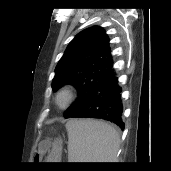 Aortic arch graft infection (FDG PET-CT) (Radiopaedia 71975-82437 C 56).jpg