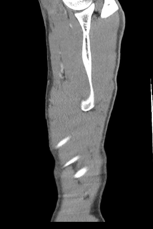 Aortic coarctation with aneurysm (Radiopaedia 74818-85828 B 152).jpg