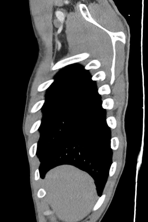 Aortic coarctation with aneurysm (Radiopaedia 74818-85828 B 25).jpg