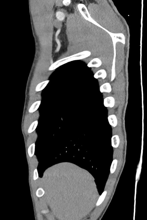 Aortic coarctation with aneurysm (Radiopaedia 74818-85828 B 26).jpg