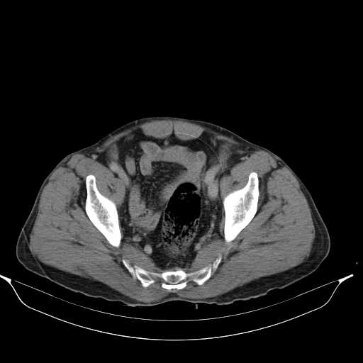 File:Aortic dissection- Stanford type A (Radiopaedia 22085-22085 Axial C+ delayed 46).jpg