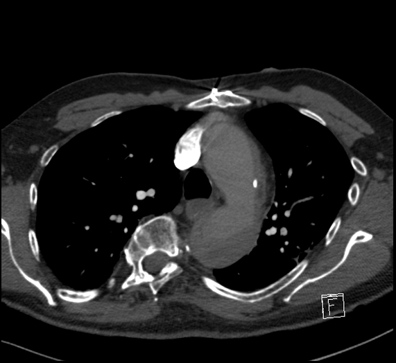 File:Aortic dissection (CTPA) (Radiopaedia 75506-86751 Axial C+ CTPA 46).jpg