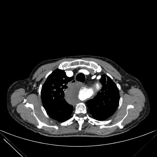 Aortic dissection (Radiopaedia 27466-27665 C+ arterial phase 18).jpg
