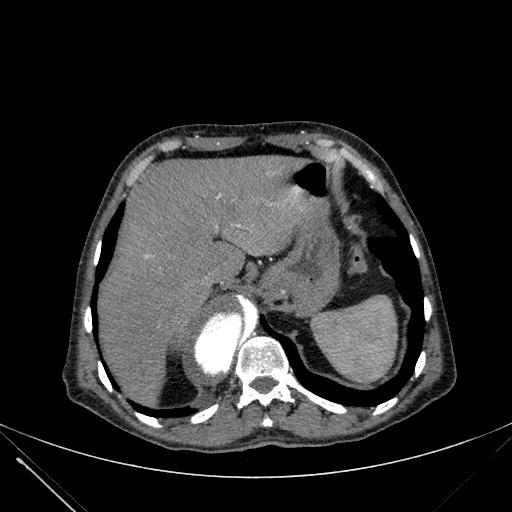 Aortic dissection (Radiopaedia 27466-27665 C+ arterial phase 259).jpg