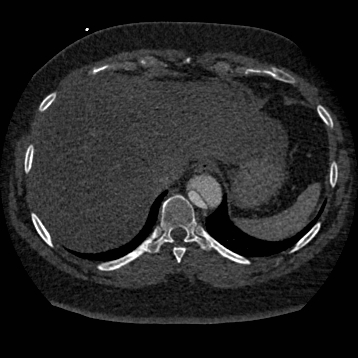 Aortic dissection (Radiopaedia 57969-64959 A 262).jpg