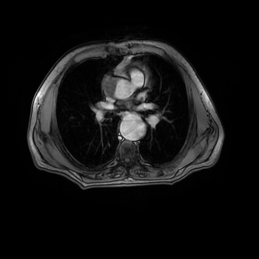 Aortic dissection - Stanford A - DeBakey I (Radiopaedia 23469-23551 Axial MRA 17).jpg