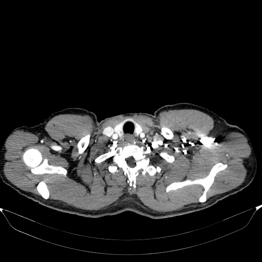 Aortic dissection - Stanford type A (Radiopaedia 83418-98500 A 4).jpg