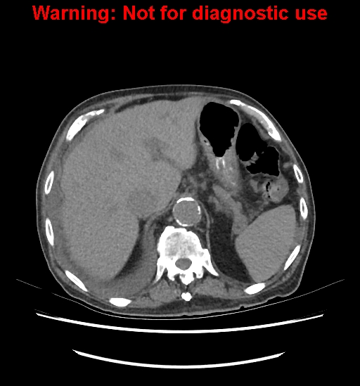 File:Aortic graft infection (Radiopaedia 44979-48907 Axial non-contrast 27).jpg