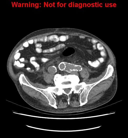 File:Aortic graft infection (Radiopaedia 44979-48907 Axial non-contrast 67).jpg