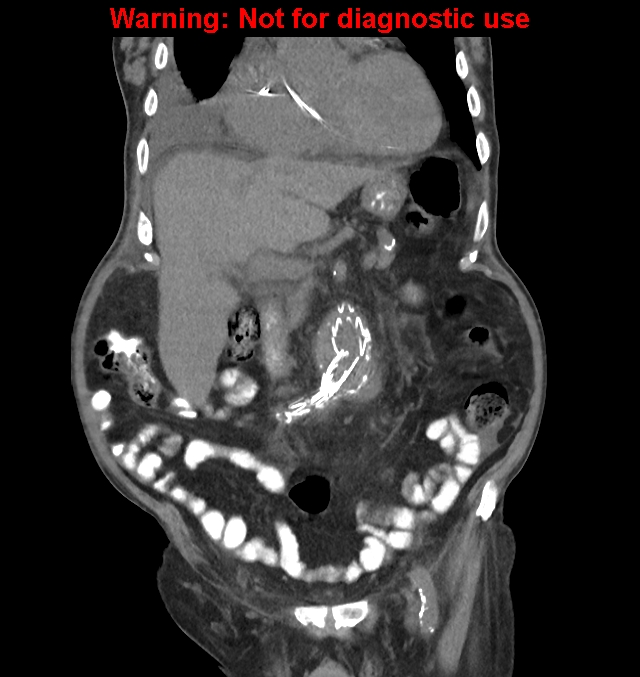 Aortic graft infection (Radiopaedia 44979-48907 non-contrast 19).jpg