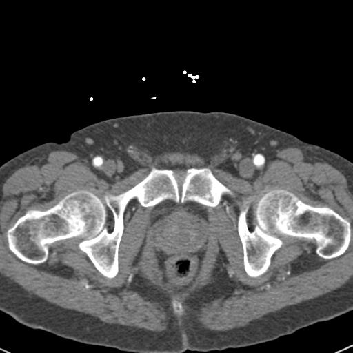 Aortic intramural hematoma (Radiopaedia 31139-31838 B 169).jpg