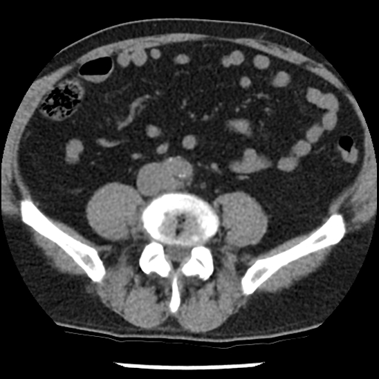 Aortic intramural hematoma (type B) (Radiopaedia 79323-92387 Axial non-contrast 84).jpg