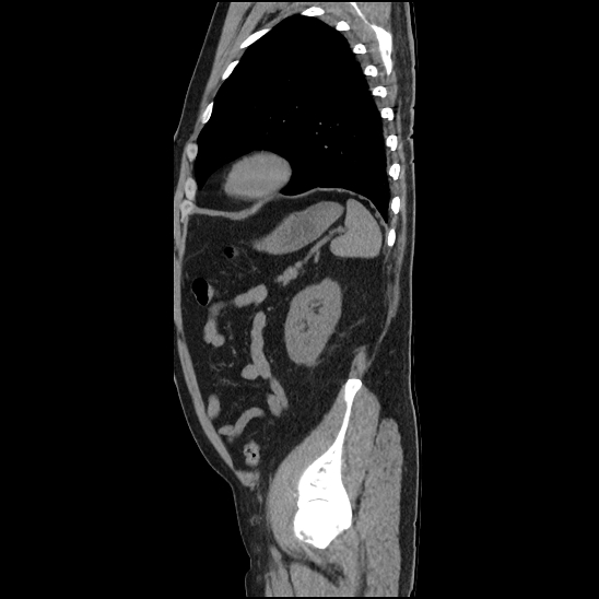 Aortic intramural hematoma (type B) (Radiopaedia 79323-92387 G 43).jpg